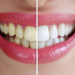 before and after teeth whitening comparison